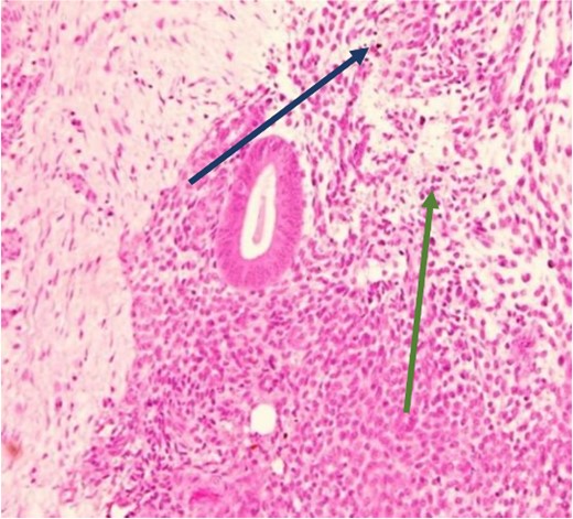 High power showing plasma cells in the stroma consistent with chronic endometritis (H&E).