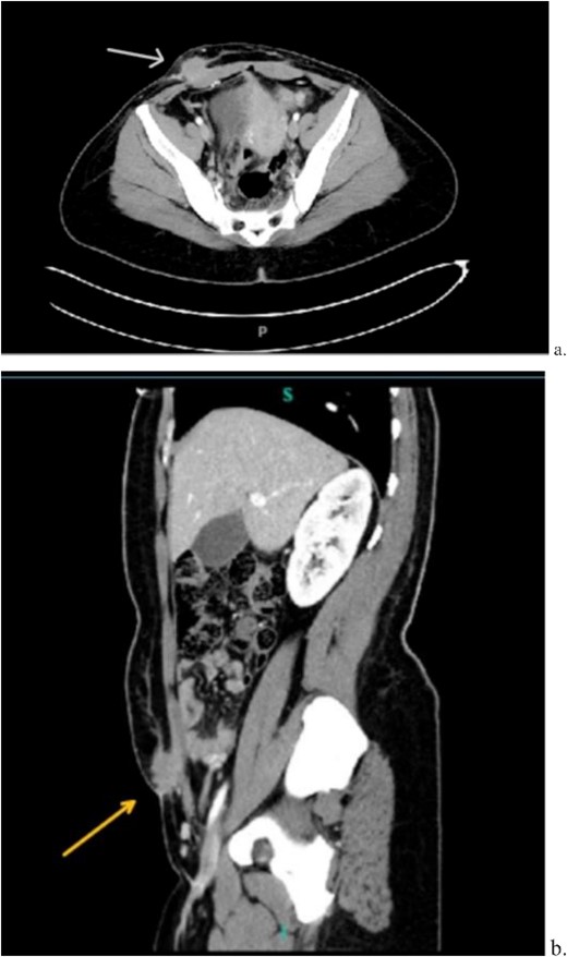 Computed tomography axial (a) and sagittal (b) views of a 2.2 × 2.0 cm enhancing mass on the abdominal wall (arrows).
