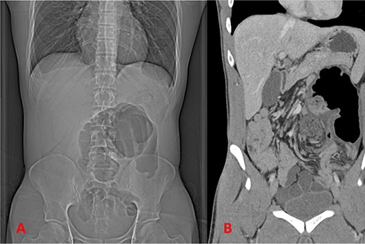 Imaging showing findings concerning for volvulus of the large intestine; (A) plain film of abdomen; (B) coronal CT imaging.