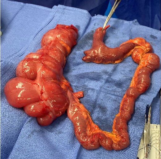 Surgical specimen of en bloc resection of redundant colon, small bowel, and Meckel’s diverticulum; instrument is identifying based of mesodiverticular band.