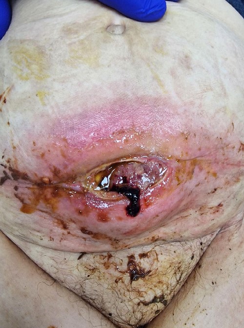 Clinical presentation of the metastasis as enterocutaneous fistula.