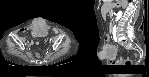 (A–B) Contrast-enhanced abdominal CT scan showing intraabdominal tumor that infiltrates the abdominal wall and the surrounding skin (A-axial scan, B-sagittal scan).
