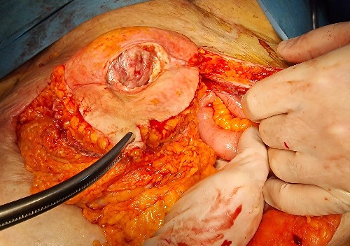 Caudal extension of the laparotomy with partial resection of the abdominal wall along with the enterocutaneous fistula.