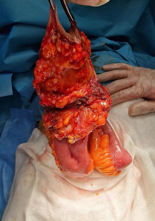 The operative specimen before detachment (resection of the small intestine).