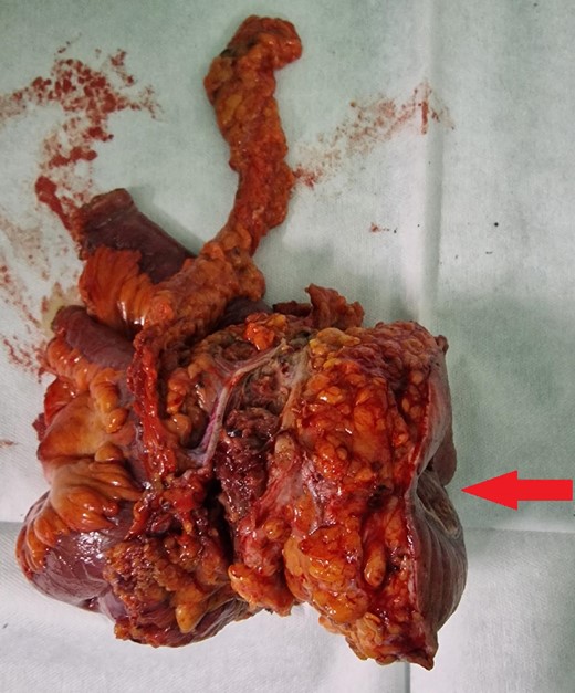 Resected specimen containing part of the small intestine with metastasis, part of the abdominal wall, and the skin with enterocutaneous fistula (arrow).