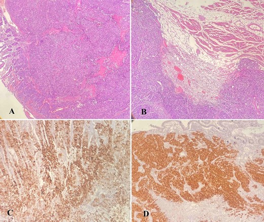 (A–D) Histology analysis; (A) tumor cells infiltrating the wall of the small intestine with mucosal ulceration (hematoxylin–eosin stain, ×40); (B) neoplastic cells infiltrating skeletal muscle of the abdominal wall (hematoxylin–eosin stain, ×40); (C) positive staining for CK7, ×100; (D) positive staining for PAX8, ×100.