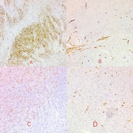 Desmin is focally positive in tumor cells (A); actin is negative in tumor cells (B); S100 reveals mild focal nuclear positivity (C); ki67 proliferative index <10% (D).