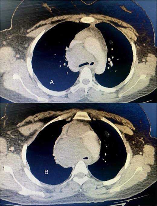 (A) The tumor extends up to the tracheal carina and compresses on the aortic arch; (B) a tumor in the mediastinum closes the trachea almost completely, deflects it toward the left, and infiltrates the aortic arch and the vena cava.