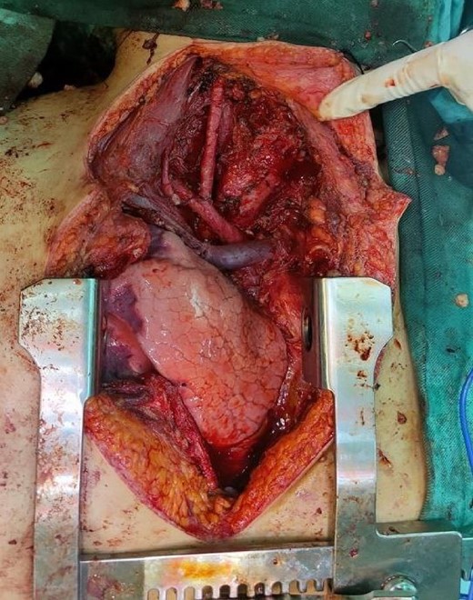 Wide Kocher incision, vital organs after removing the tumor.