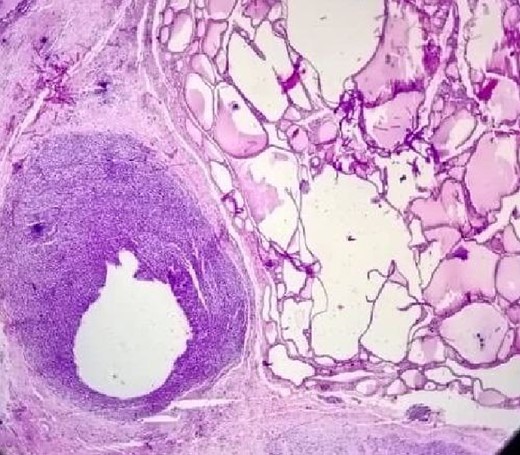 The tumor invading of the thyroid tissue.
