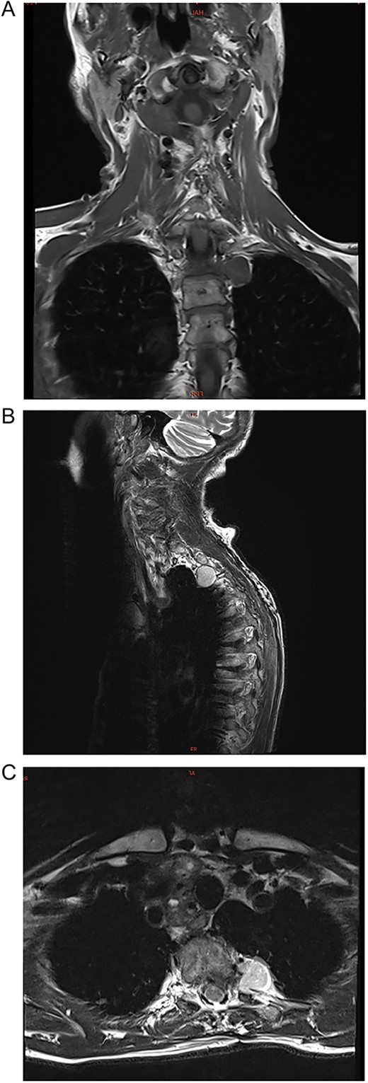(A–C) Coronal, sagittal, and axial images of a 2.7 × 2.0 × 1.2 cm para-vertebral mass in the left hemithorax at the thoracic vertebrae T2/T3 level.