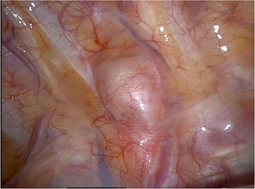 Intra-operative photo showing the lesion in situ, located in the 3rd intercostal space, close to the vertebra. It is covered with mediastinal pleura and slightly vascularized.
