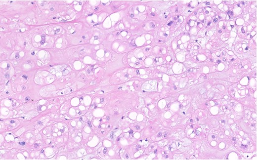 H&E stain of chordoma tissue with chondromyxoid background. The tumour cells grow in nests and cords. They contain middle sized, moderately pleomorphic nuclei with small nucleoli and broad, and often vacuolated eosinophilic cytoplasm, all features typical for chordoma tissue.