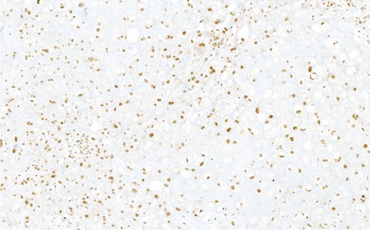 Immunohistochemical reaction for chordoma-specific antibody brachyury, demonstrating typical nuclear expression.