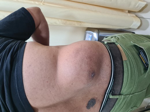 Clinical photograph of the large lesion in the right flank.