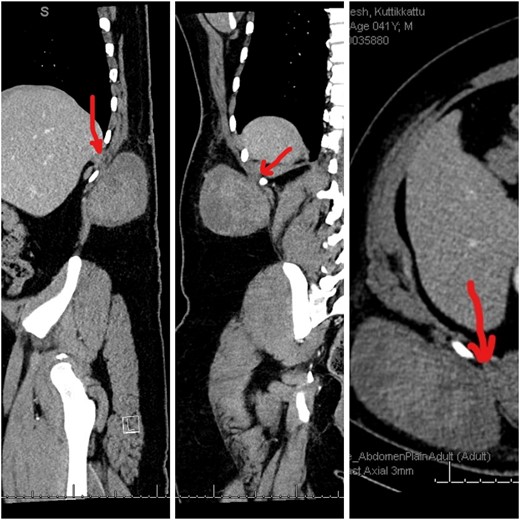 CT images showing the heterogenous lesion in the right flank with the loss of fat plane between the lesion and the underlying muscle at one place.