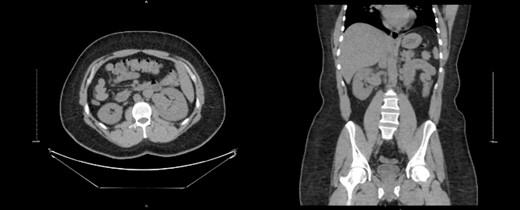 CT KUB showed multiple prominent structures with communication between the arterial and venous systems at the right renal hilum, suggestive of an intrarenal arteriovenous malformation (AVM).