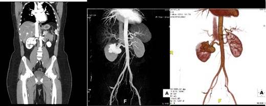 Run-off computed tomography angiography (CTA) showed right kidney hilum tortuous vascular arteriovenous communication of the arterial and venous system represents intrarenal AVM towards the upper pole measuring 2.9 cm.