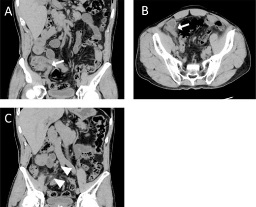 Computed tomography (CT) examination and postoperative pathological examination. Coronal (A) and horizontal (B) views show an enlarged appendix (white arrows). The coronal section (C) also shows enlarged regional lymph nodes (white arrowheads).