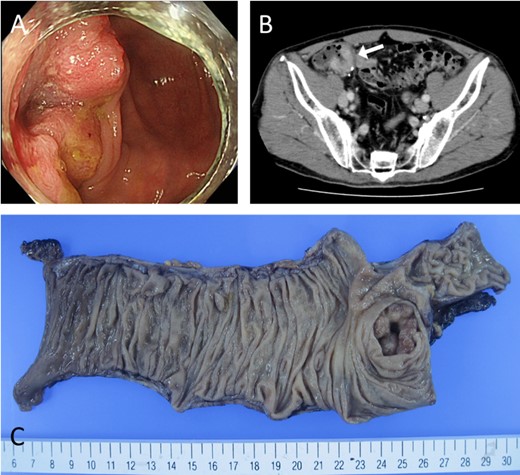 Preoperative evaluation for caecal cancer. (A) Colonoscopy reveals a type 2 lesion in the caecum with a central ulcer. (B) Contrast-enhanced CT shows that the tumour area was highly stained. (C) Macro-pathological examination reveals a type 2 lesion in the cecum.