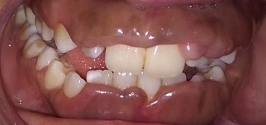 Phenytoin induced gingival enlargement.