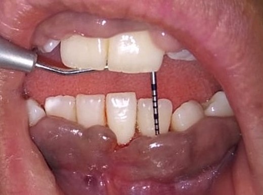 Measuring the periodontal pocket of lower anteriors showing gingival enlargement.