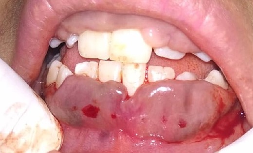 Bleeding points marked.