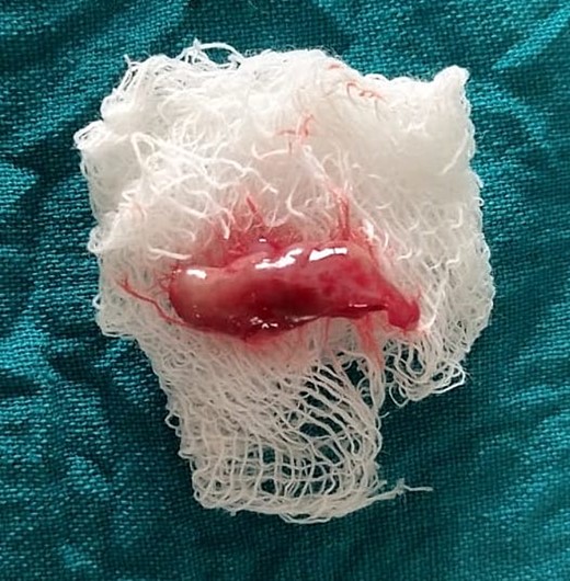 Excised tissue.