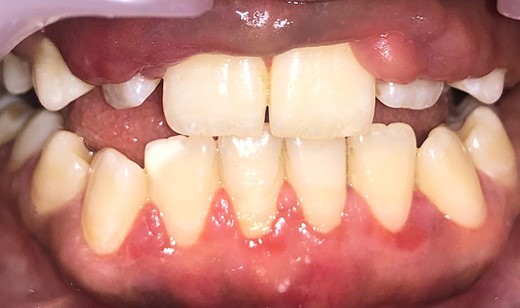 Post healing of gingiva.