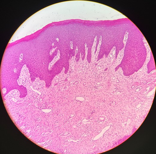 Histopathological picture showing hyperplastic para keratinized stratified squamous epithelium with long rete ridges, chiefly, inflammatory cells in the connective tissue.