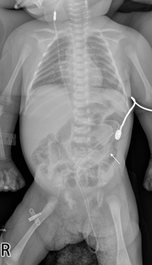 A babygram X-ray demonstrates the distal tip of the shunt positioned at the level of the left paravertebral L4 (white arrow), with a portion of the shunt extending downward and protruding from the abdominal cavity.
