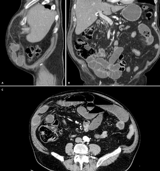 A: CT, Multiple dilated bowel loops within the hernia. B: CT, No Pneumobilia is seen. C: CT, Diffuse dilation with multiple air-fluid levels.