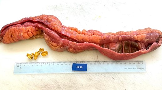 Pathology, bowel segment occupied by fragments of mixed calculi of 3 × 2 x 1 cm, The gallstone was impacted in an area of stenosis that obstructs 40% of its lumen.