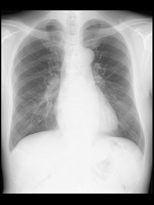 A chest radiograph in the upright position before surgery.