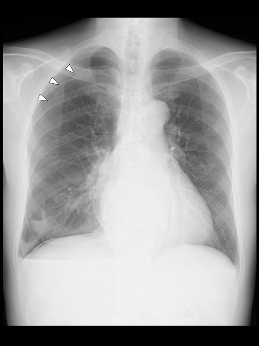 A chest radiograph in the upright position on POD 1 showing a right pneumothorax (arrowheads).