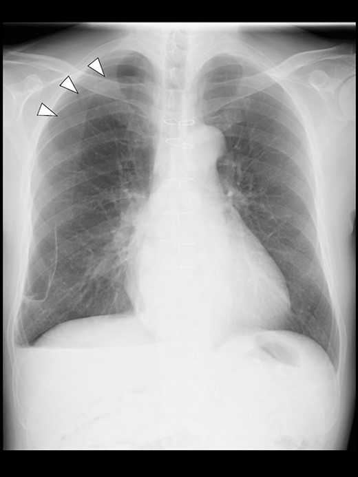 A chest radiograph in the upright position on POD 3 showing a residual right pneumothorax (arrowheads).