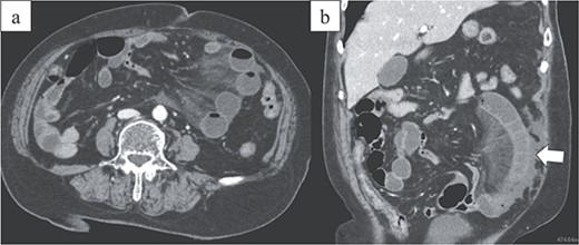 Images from enhanced CT. (a) Arterial-phase axial CT shows a hypo-enhancing small bowel in the left lower abdominal quadrant. (b) Arterial-phase coronal CT coronal enhanced CT shows a closed-loop obstruction of the hypo-enhancing small bowel (arrow).