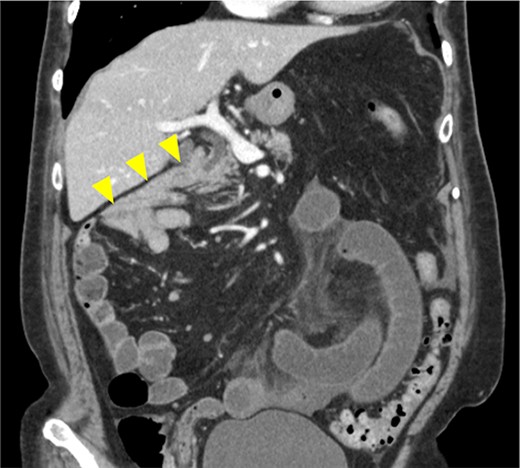 Image from enhanced CT. Contrast-enhanced CT shows the absence of a horizontal duodenal leg and the duodenum running caudally to the jejunum (arrowhead).
