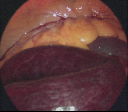 Intraoperative image. Laparoscopic examination of the abdominal cavity shows necrosis of the small bowel.