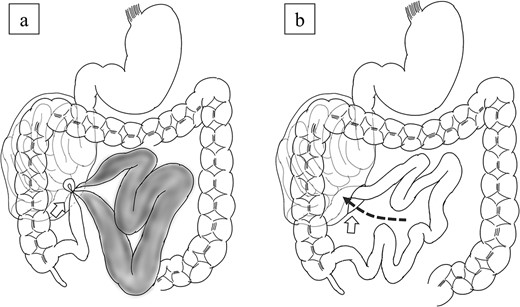 Scheme of the operative findings. (a) A 6-cm hernial orifice (arrow) was observed at the fusion defect between the right mesocolon and retroperitoneum. Intestinal necrosis was observed in 80 cm of the ileum within the abdominal cavity outside the hernial sac and no intestinal necrosis was observed in the small intestine within the hernial sac. (b) The jejunum had migrated to the inside of the hernial sac through the orifice (arrow).