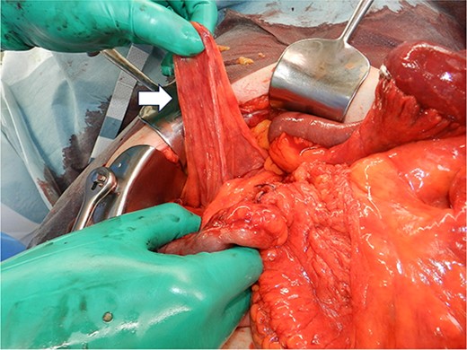 Intraoperative image showing that the hernial sac (arrow) was 12 × 6 cm in size.