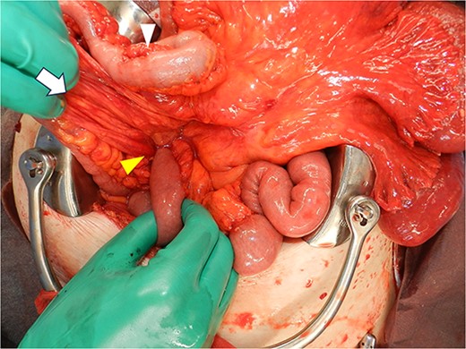 Intraoperative image after replacing the small bowel into the abdominal cavity shows that the duodenum did not form a horizontal leg and ran caudally from the descending leg in the hernial sac to the jejunum. Proximal jejunum, lower arrowhead; hernial sac, arrow; terminal ileum, upper arrowhead.