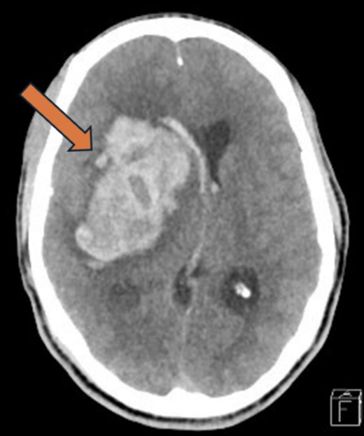 Head CT-Scan showing large intraparenchymal hematoma involving the right basal ganglia and temporal lobe with surrounding edema, extending into the lateral, third, and fourth ventricles, causing a midline shift of 13 mm with effacement of the right lateral ventricle and adjacent sulci.