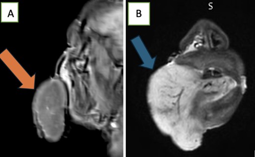 MRI Tongue shows significant macroglossia as seen in the (A) and (B) above with significant vascular engorgement these MRI features along with its subacute evolution are suggestive of being angioneurotic.