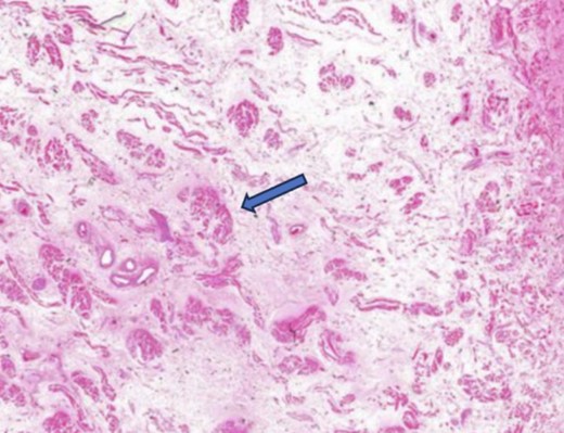 A microscopic study of the patient’s tongue tissue revealed chronic inflammation, fat infiltration in the submucosa, and striated muscle degeneration.
