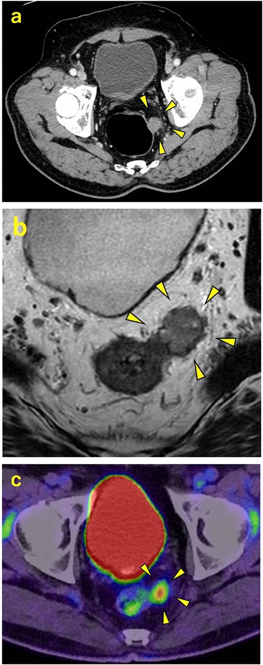 Contrast-enhanced CT, contrast-enhanced MRI, and PET. (a) CT showing a 20-mm large extramural growth-type mass on the left wall of the rectum, 9 cm from the anal verge. (b) MRI showing that the mass may have originated from the muscularis propria of the rectum. (c) PET showing an accumulation in the mass with a maximum standardized uptake value of 5.96.