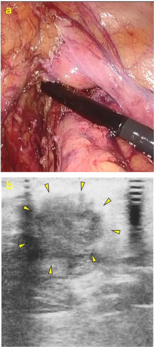 Intraoperative ultrasonography. (a) A laparoscopic ultrasonography probe was applied to the mesorectum to identify the mass. (b) A hypoechoic area of ~20 mm
