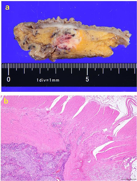 The resected specimen. (a) The resected specimen: a well-defined 18 × 16 mm large borderline mass predominantly located on the lower rectal adventitia. (b) HE (×40) specimen showing mass compressing the muscularis propria after an increase in size.
