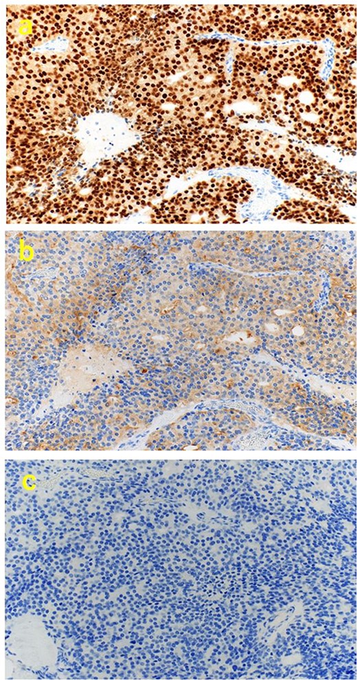 Immunohistochemical findings. (a) (×200) positive for NKX3.1, (b) (×200) partially positive for PSA, and (c) (×200) negative for CDX2.