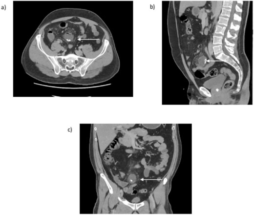 CT abdomen and pelvis (a) transversal, (b) sagittal, and (c) coronal view. An arrow indicates the inflamed blind ending structure of the small bowel with calcified bodies.